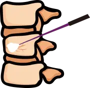 척추성형술 3단계: 의료용 골시멘트 정밀 주입