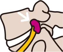 시술 방법 3단계: 약물 투여를 통한 신경 유착 박리