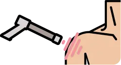 어깨 석회성 건염의 석회질 파쇄 및 제거 안내