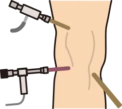 수술 기구를 이용한 손상 부위 치료 단계