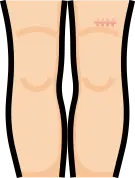 수술 흉터 관련 Q&A