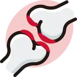 연골판 손상 방치 시 조기 퇴행성 관절염 진행 안내