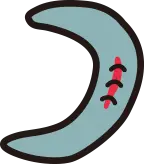 파열된 연골판을 꿰매어 연결하는 연골판 봉합술 안내