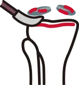 봉합 불가 시 시행하는 연골판 절제술 및 정리 단계 안내