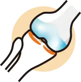 무릎 기능 복원을 위한 반월상 연골판 이식술 안내