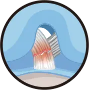 급격한 방향 전환 및 착지 시 발생하는 전방 십자인대 파열 기전