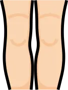 다리 축 교정 후 무릎 바깥쪽으로 체중이 분산되는 효과 안내