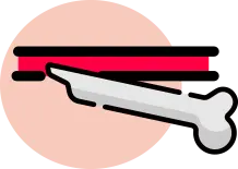 주변 혈관 및 신경 손상을 동반한 골절 수술 필요 안내