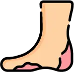 당뇨병성 감각 소실로 인한 발 상처 방치 위험성 안내