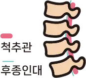 척추관 신경 통로 바로 앞 후종인대의 해부학적 위치 안내