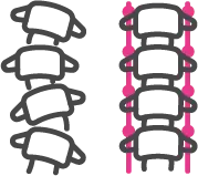 고도 척추측만증 교정을 위한 척추 교정 및 유합술 안내 아이콘