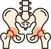 연골 마모로 인해 뼈가 부딪히는 퇴행성 고관절염 상태 안내