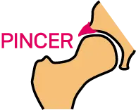 비구 부위가 과도하게 돌출된 핀서(Pincer)형 고관절 충돌 형태 안내