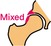 캠형과 핀서형 특징이 동시에 나타나는 혼합형 고관절 충돌 형태 안내