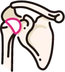 말기 어깨 관절염 해결을 위한 인공관절 치환술 형상