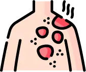 손과 발바닥에 나타나는 접촉성 피부염 증상 이미지