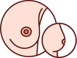 안쪽으로 당겨진 함몰 유두 증상 이미지