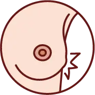 유방 내부의 딱딱한 멍울 발생 증상 이미지