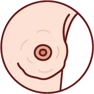 유방 표면이 울퉁불퉁하게 변한 멍울 이미지