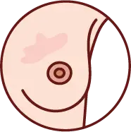 유방 피부의 붉은 발진 및 가려움 증상 이미지