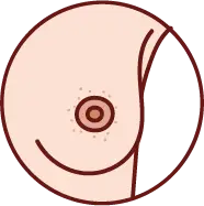 유륜 부위의 습진 및 발진 증상 이미지