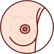 오렌지 껍질처럼 변한 유방 피부 결 이미지